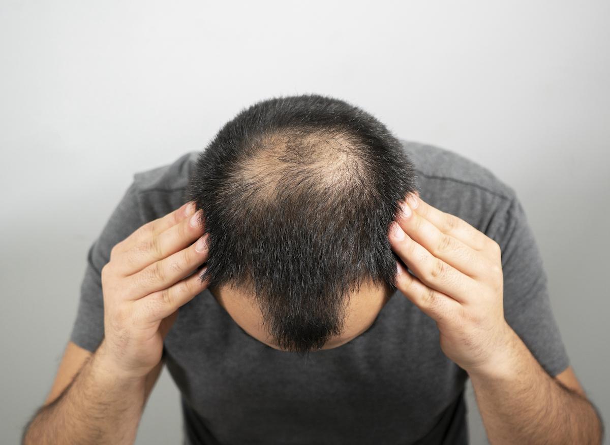 Covid-19 : les hommes chauves seraient plus à risque