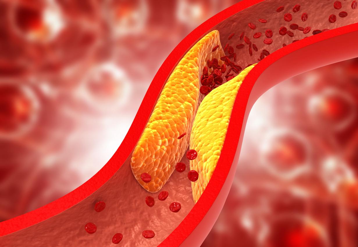 Cholestérol : comment réduire les mauvaises graisses selon un cardiologue