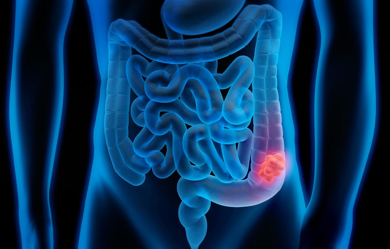 Cancer du colon : symptômes et dépistage