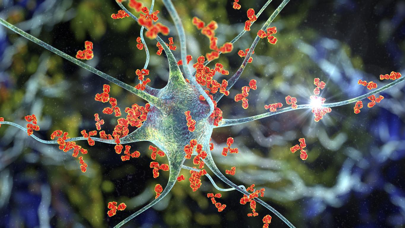 Sclérose en plaques : une inflammation chronique des neurones à l'origine de la dégénerescence