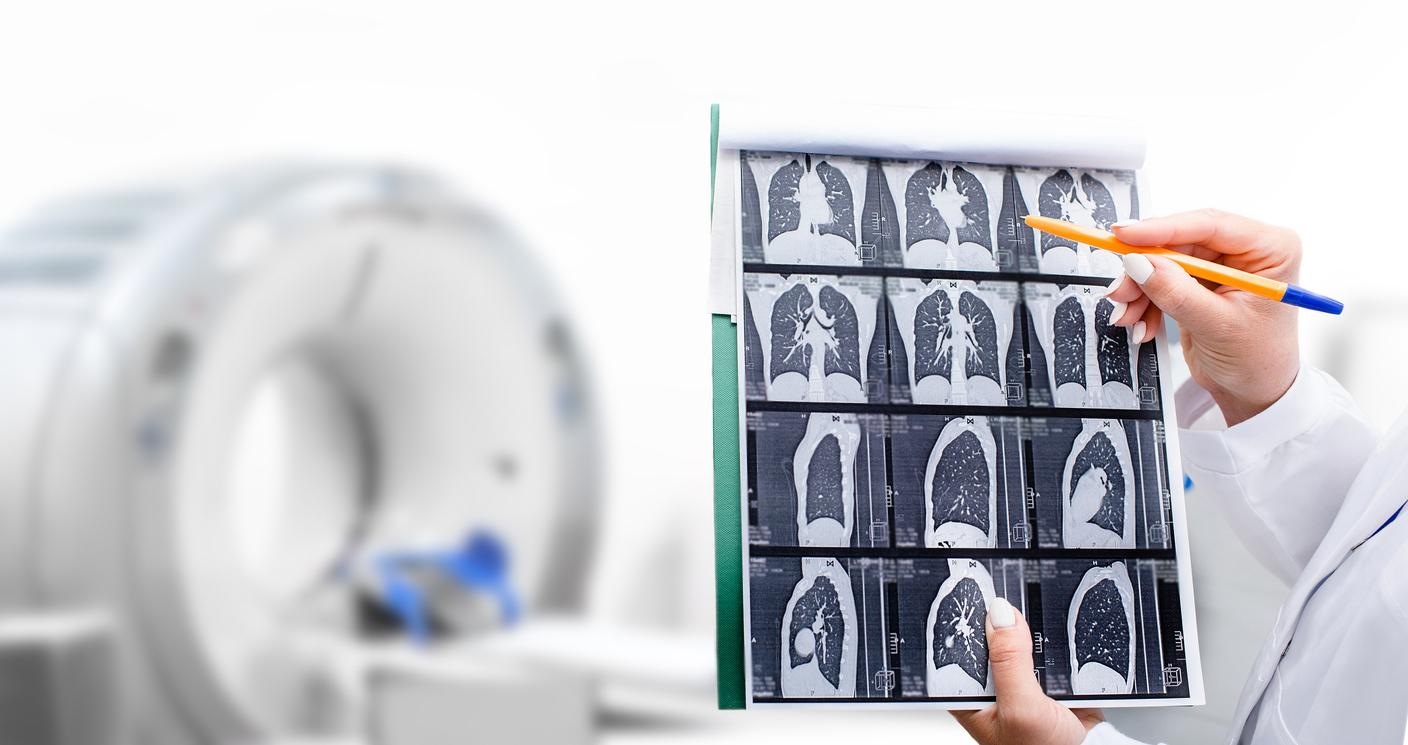 Thierry Breton : « L’INCa va lancer un programme pilote pour mettre en place un dépistage organisé du cancer du poumon »