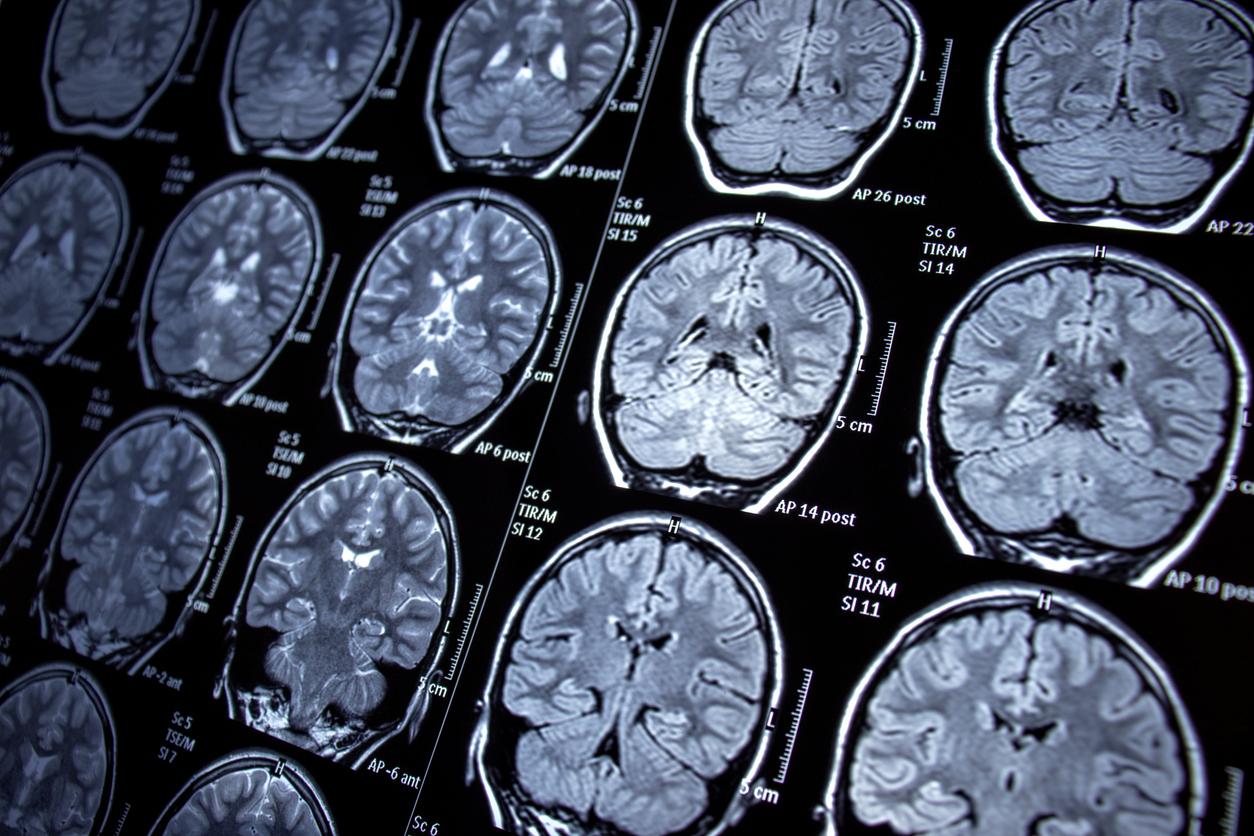 Un réseau cérébral commun à six maladies psychiatriques a été identifié