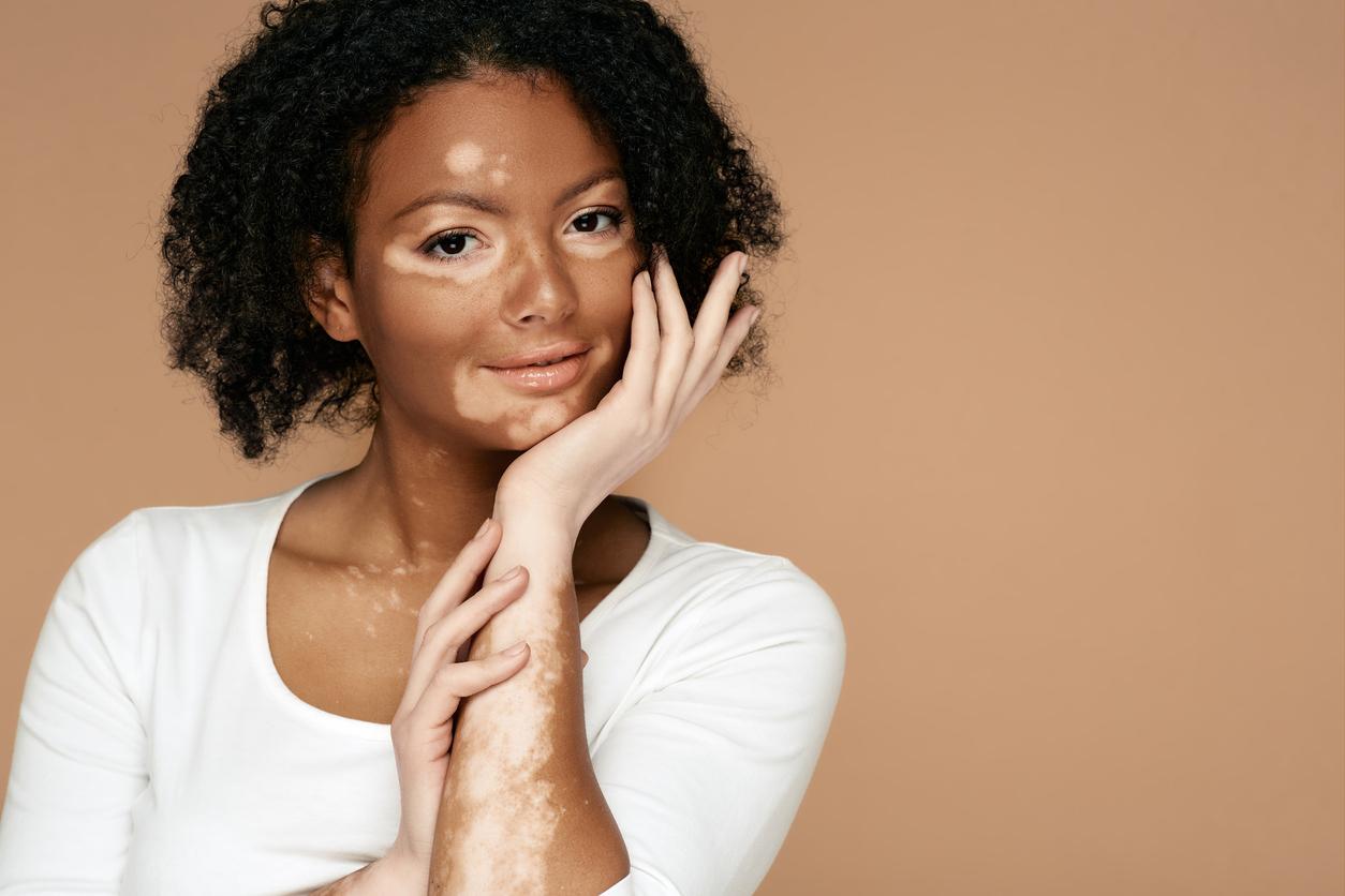 Vitiligo : plus de risque de dépression chez les patients ?