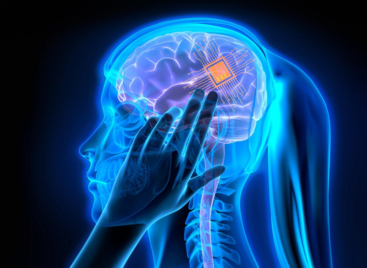 Un implant cérébral personnalisé pour traiter la dépression