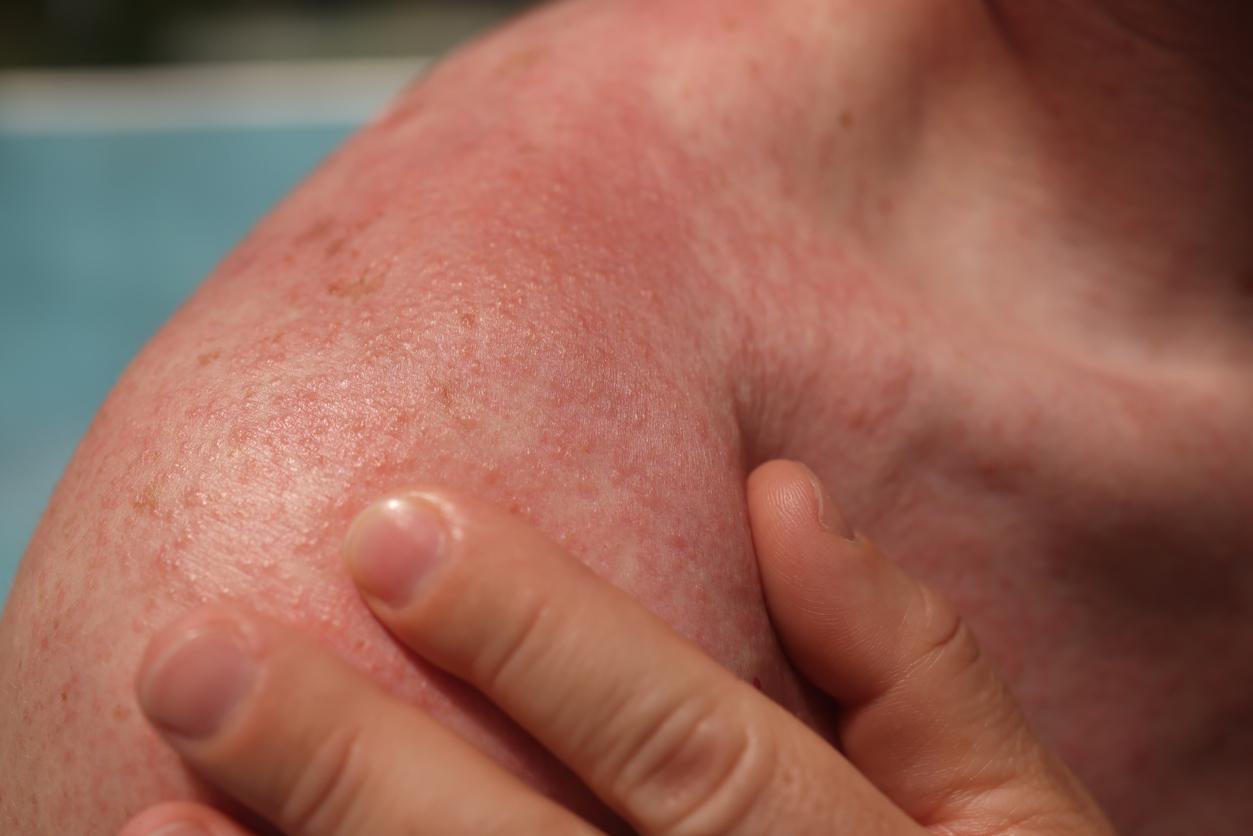 Allergies au soleil : quelles origines et comment réagir ?
