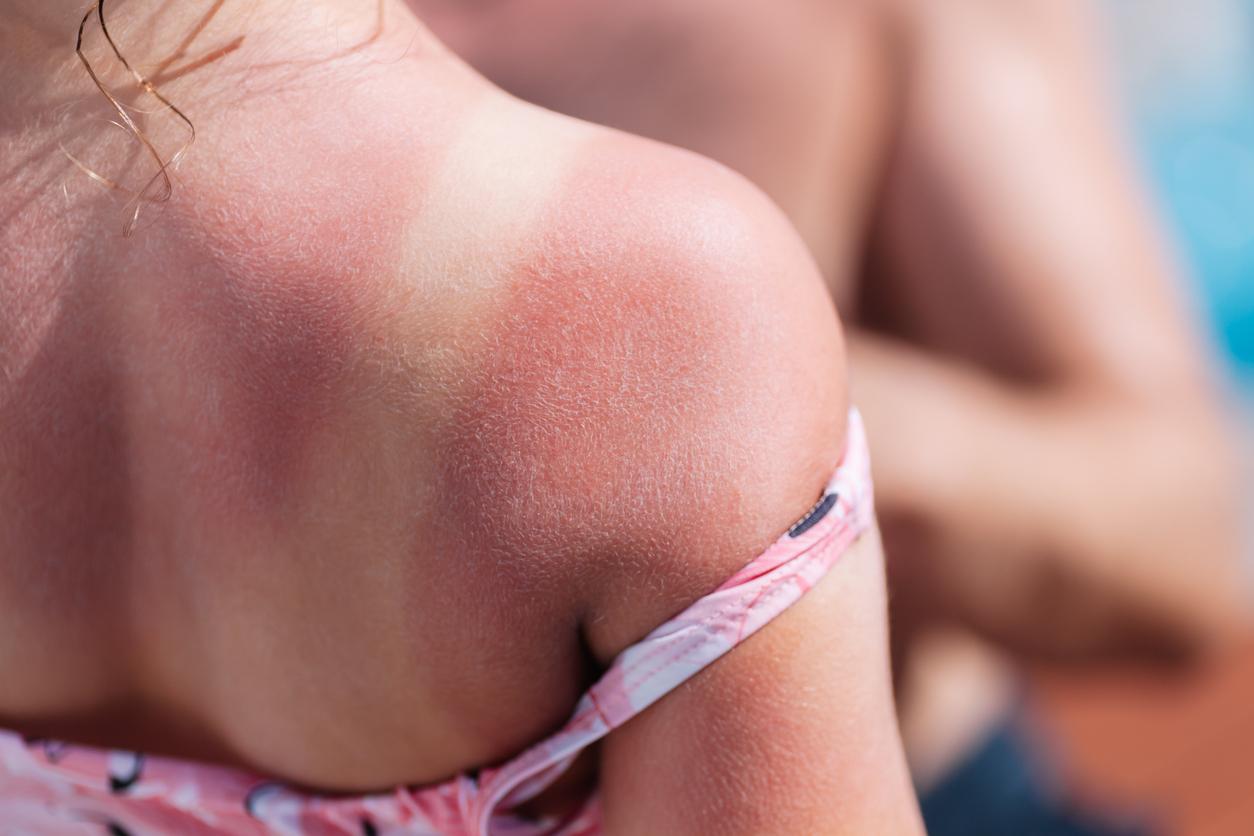 Cancer de la peau : un coup de soleil grave avant 18 ans augmente le risque 