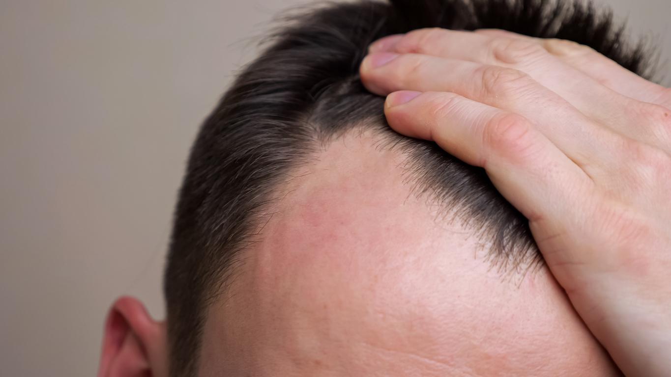 Calvitie : une nouvelle solution pour empêcher la chute des cheveux ? 