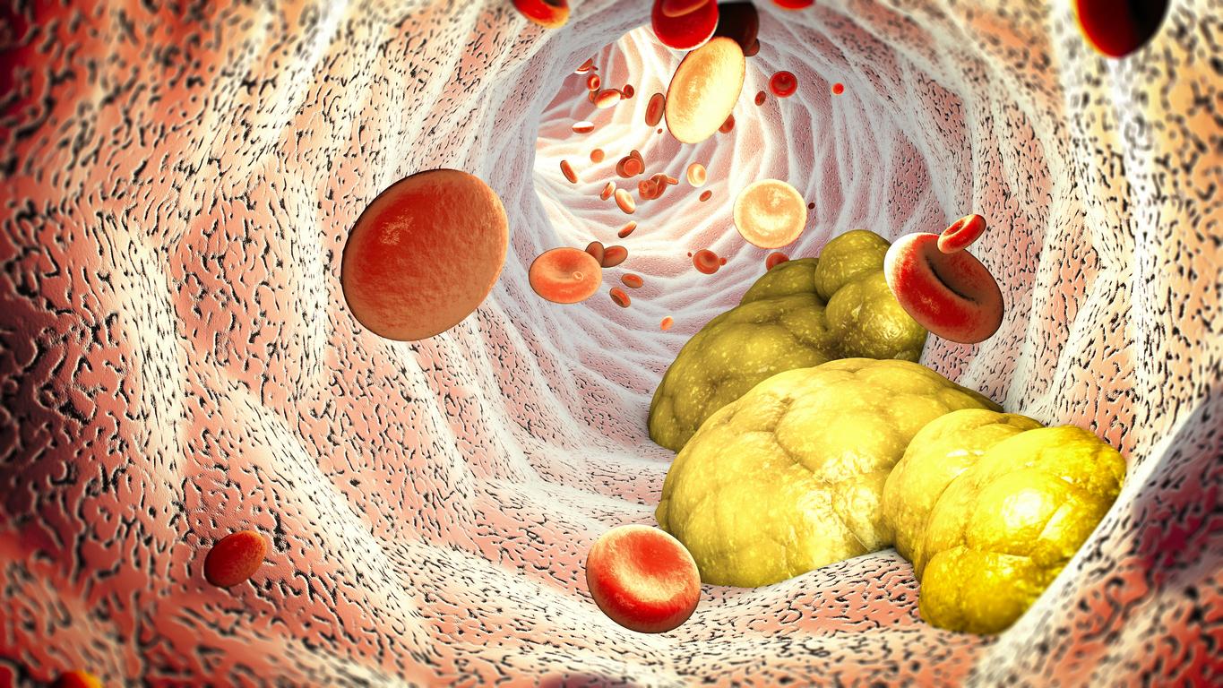 Maladie coronarienne : une variante du mauvaise cholestérol augmente les risques 