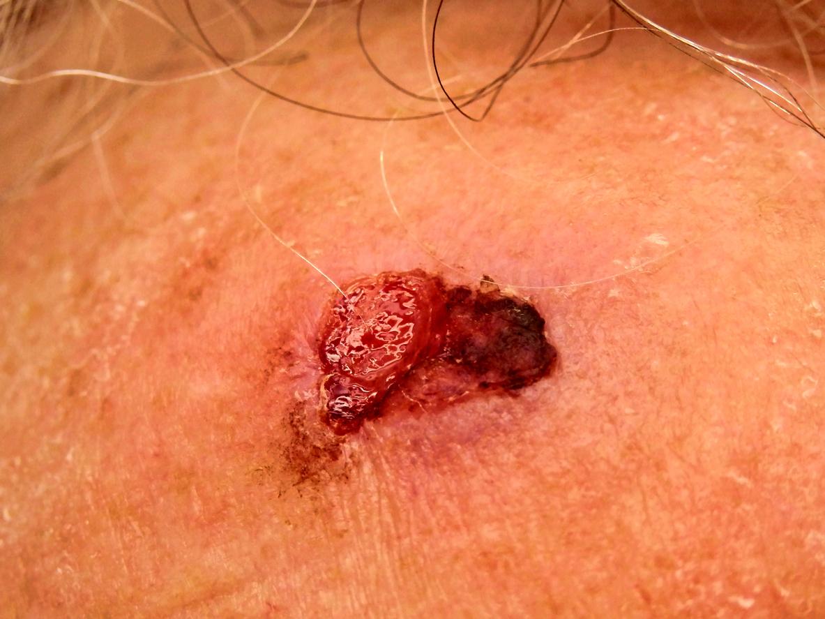 Cancer de la peau : découverte d'un marqueur qui prédit les métastases
