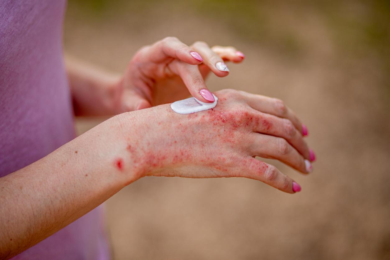 Eczéma : 8 idées reçues sur cette maladie courante de la peau