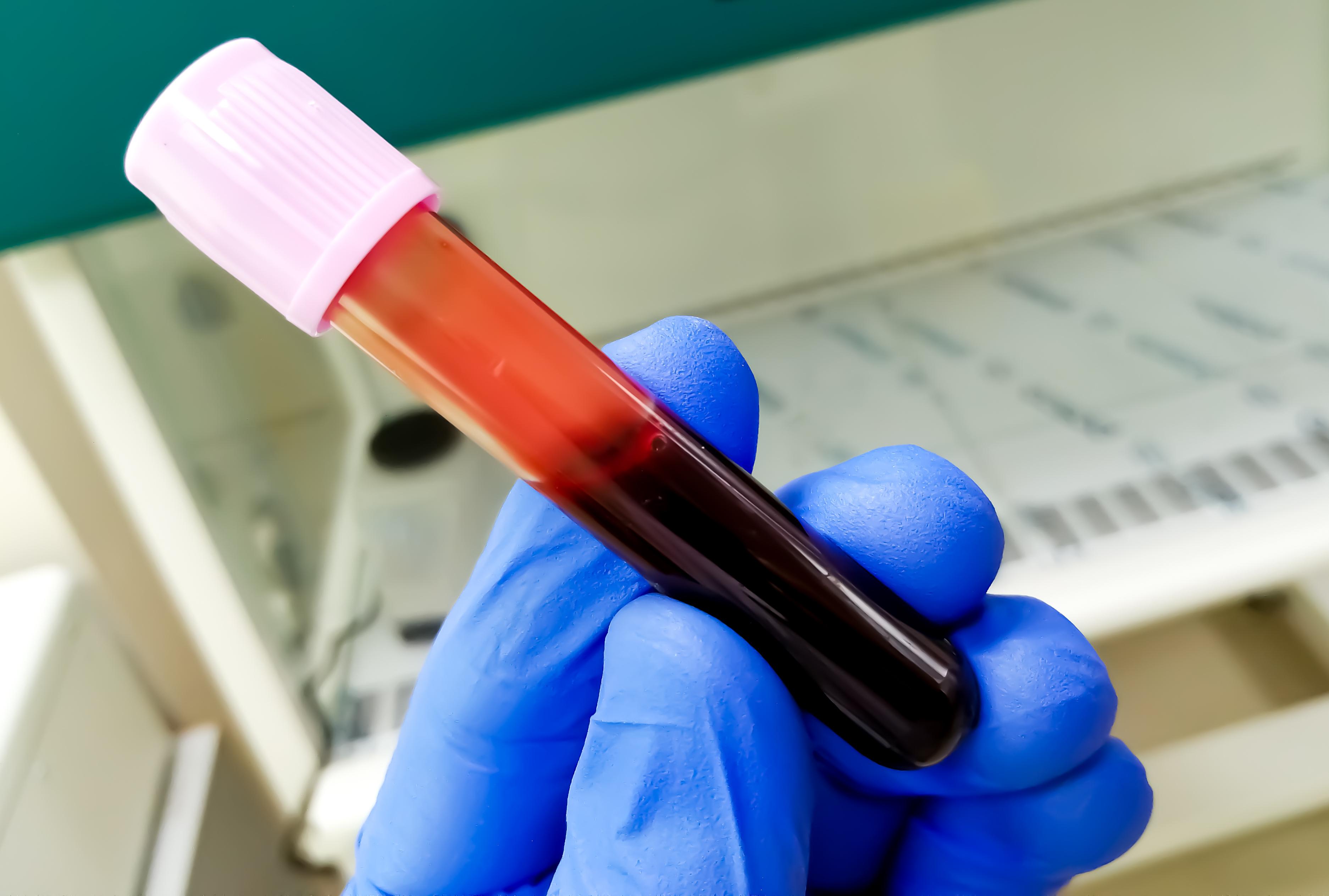 Cancer de l'ovaire : un test sanguin pourrait aider à le détecter plus tôt  