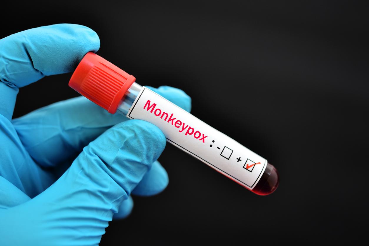 Virus : un premier cas de variole du singe identifié en Corse