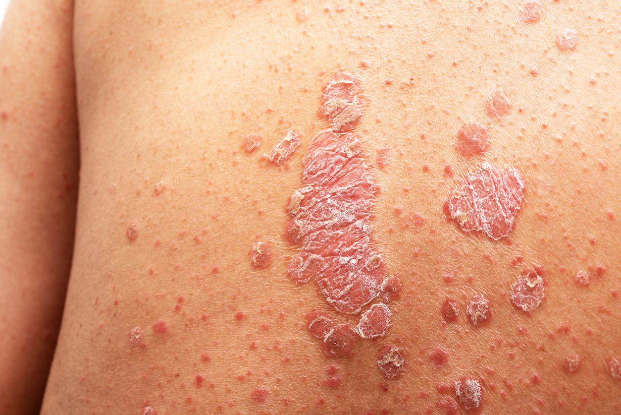 Psoriasis : 70 % des patients ont déjà souffert ou sont atteints d’au moins une maladie associée
