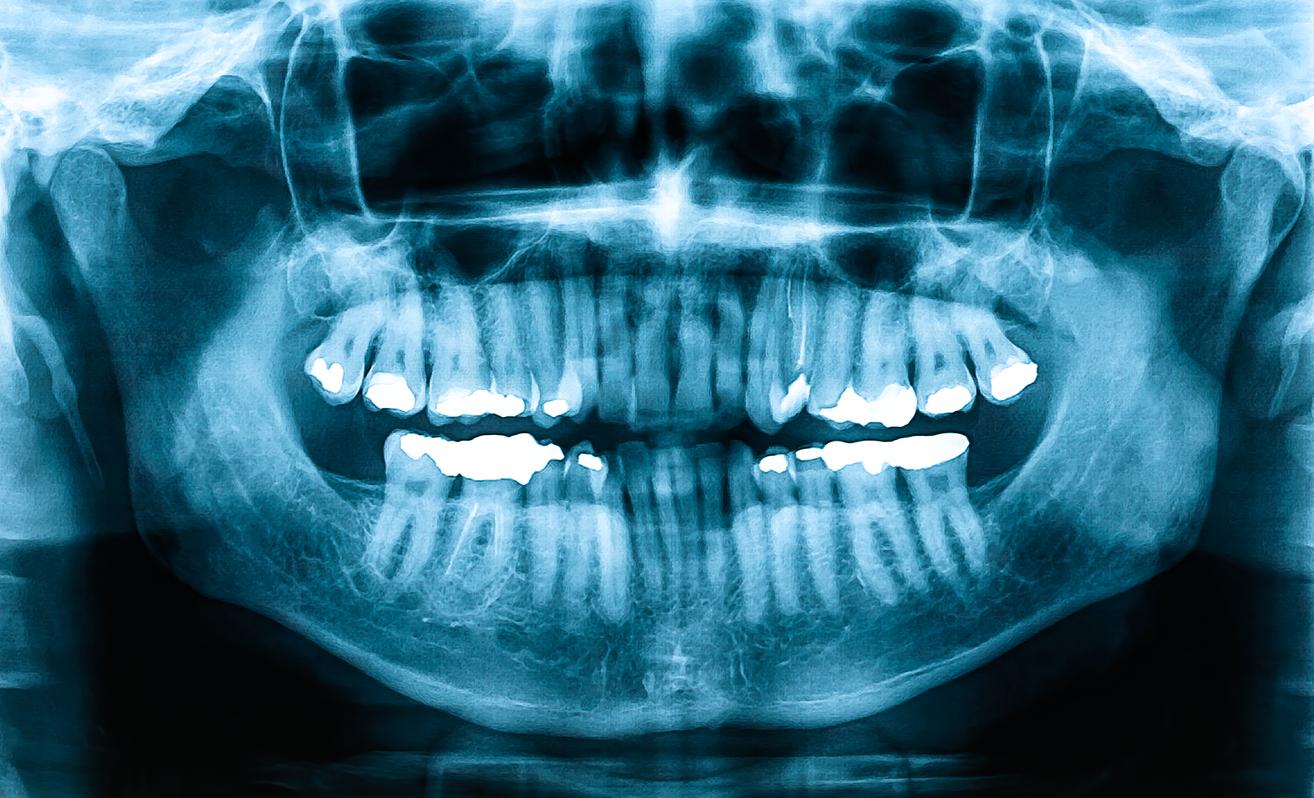 L'apnée du sommeil serait liée à des os et des dents plus faibles chez l’adulte