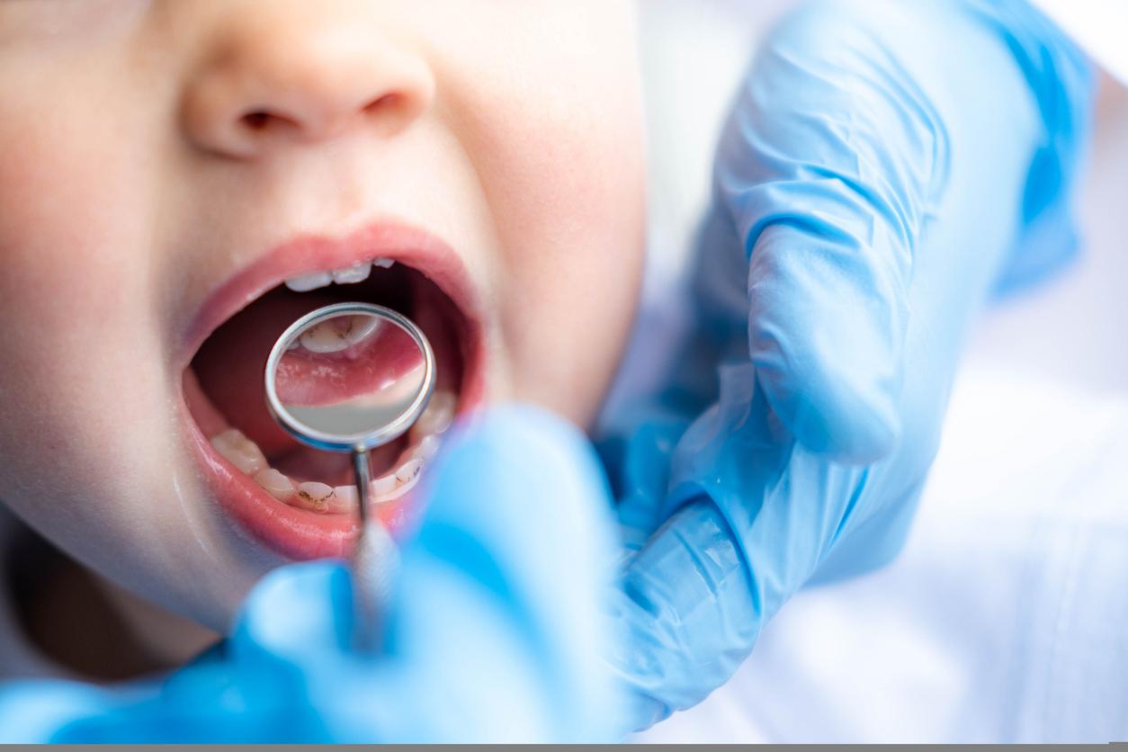 Prévention des caries : vers le remboursement de nouveaux actes