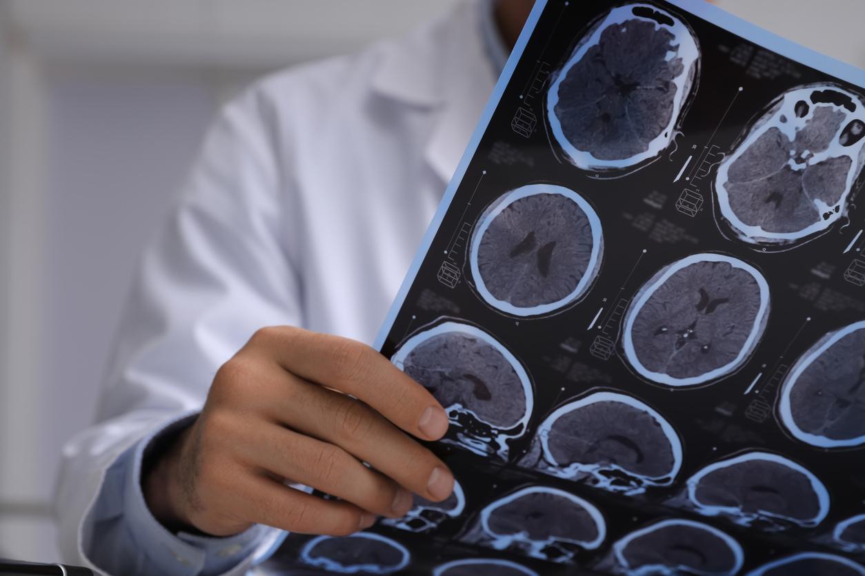 Traumatisme crânien : des implants cérébraux ont aidé 5 personnes à se rétablir