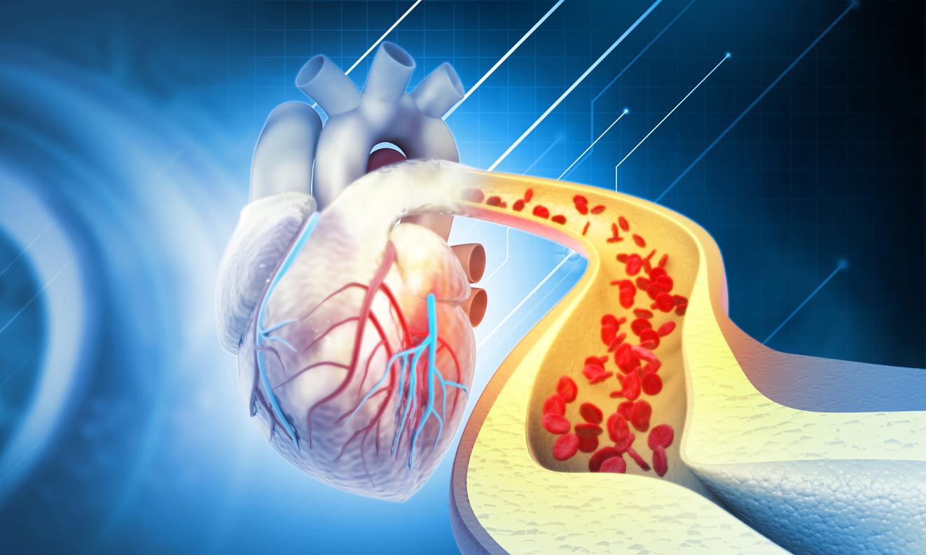 Hypercholestérolémie : la cause génétique prédit mieux les risques cardiovasculaires