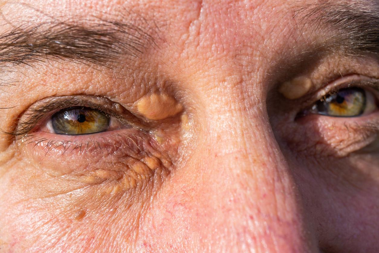 Cholestérol : vous pouvez repérer dans vos yeux certains symptômes
