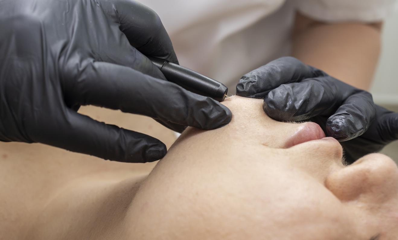 SMOP et électrolyse contre l'hirsutisme : \