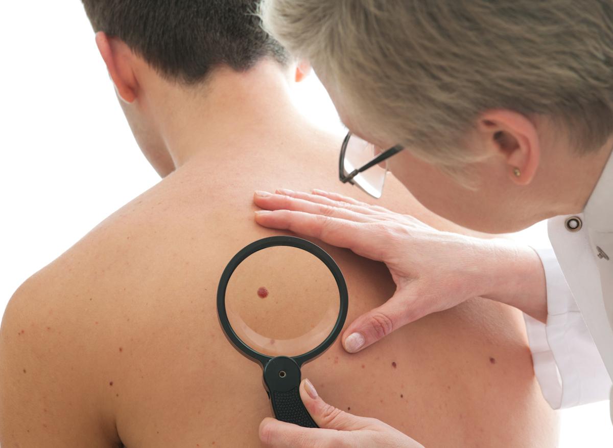 Cancer de la peau : le dépistage précoce augmente les chances de survie