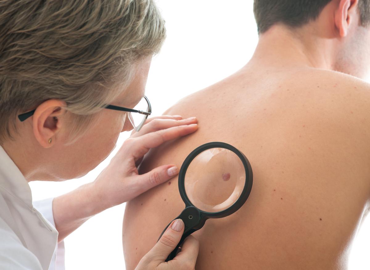 Pour éviter un cancer grave, il faut surveiller les taches sur la peau