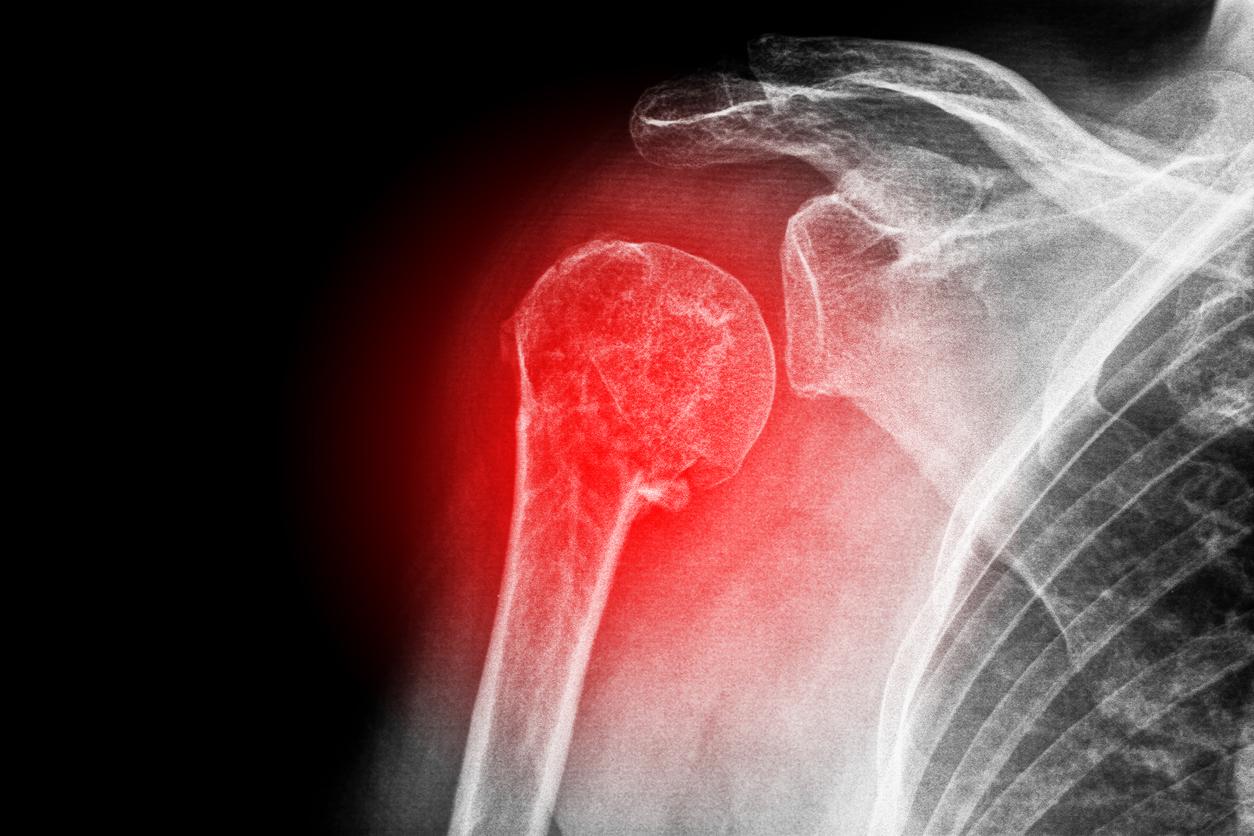 Se casser l'épaule en tombant de sa hauteur peut être le signe d'une ostéoporose