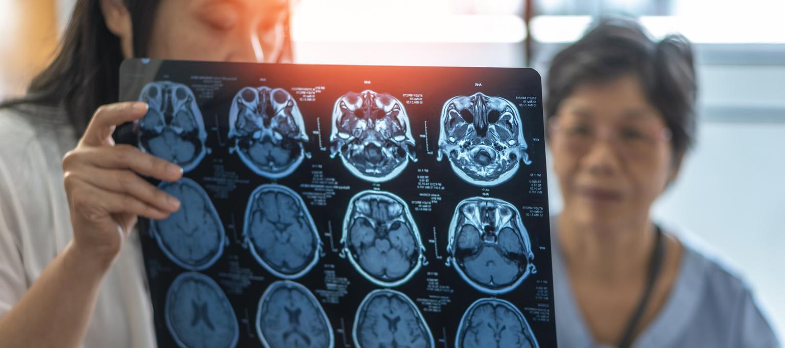 Cancer du cerveau : avoir eu des traumatismes crâniens augmente les risques