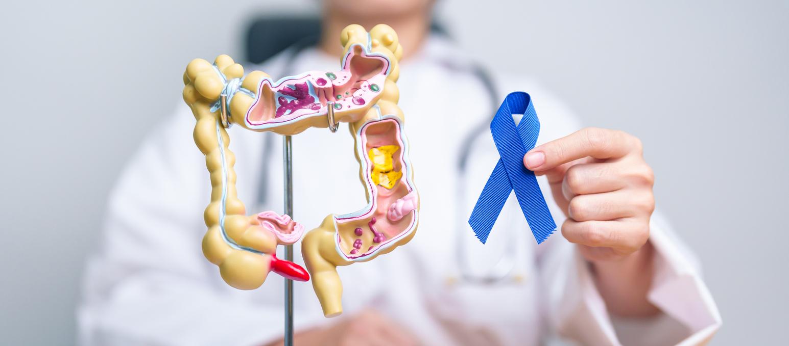 Cancer colorectal : dans quels départements se fait-on le plus dépister ? 