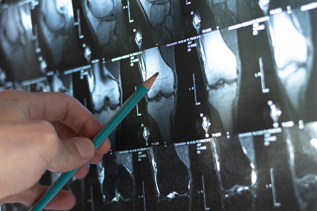 Ostéoporose : cet aliment consommé durant les fêtes aide à lutter contre cette maladie