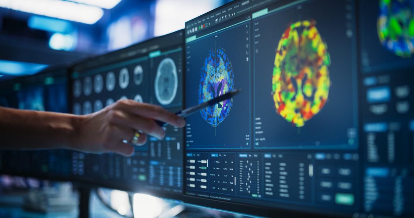 Cancer du poumon : cette empreinte cérébrale peut prédire les chances de survie