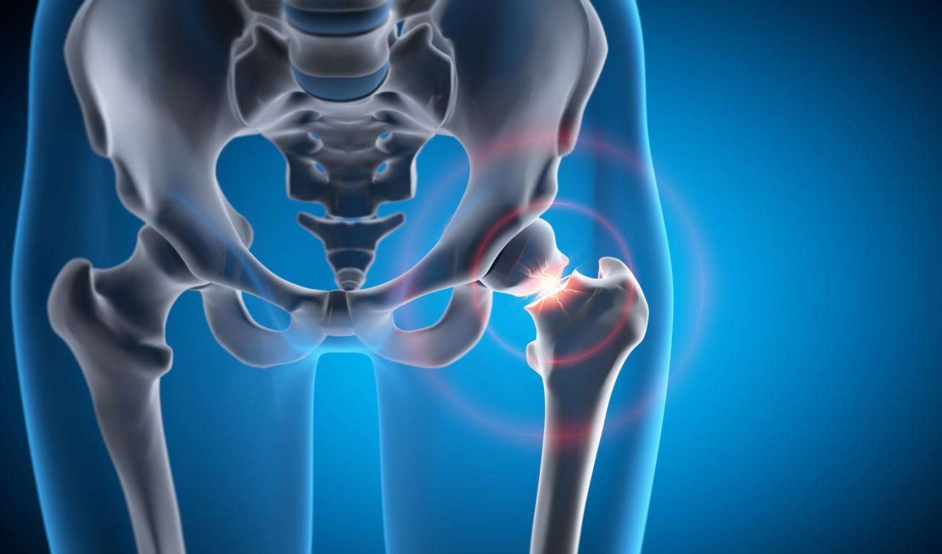 Fractures : les muscles cachent-ils un mécanisme protecteur ?