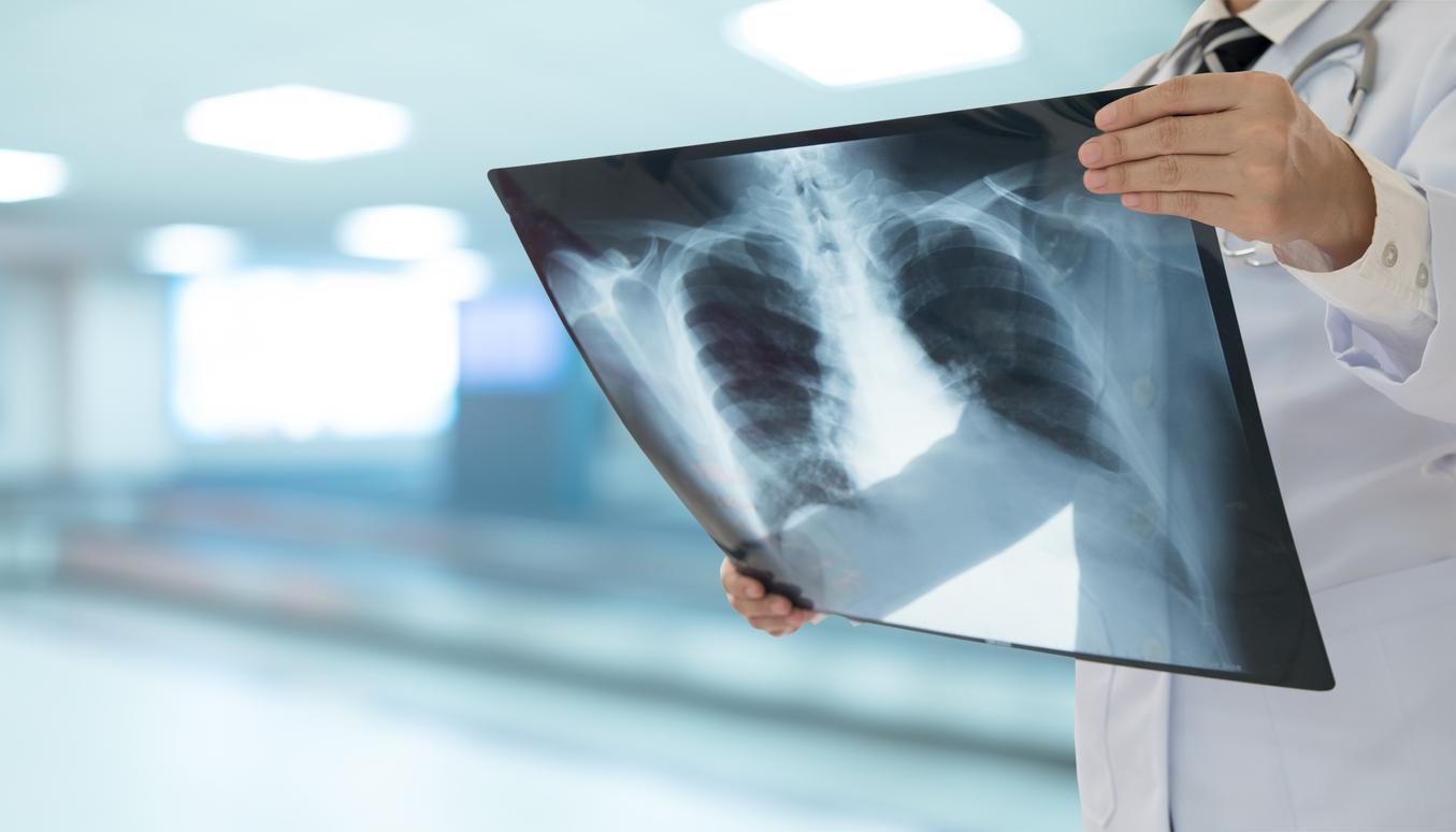 Pneumonie : ces trois facteurs aggravent vos risques 