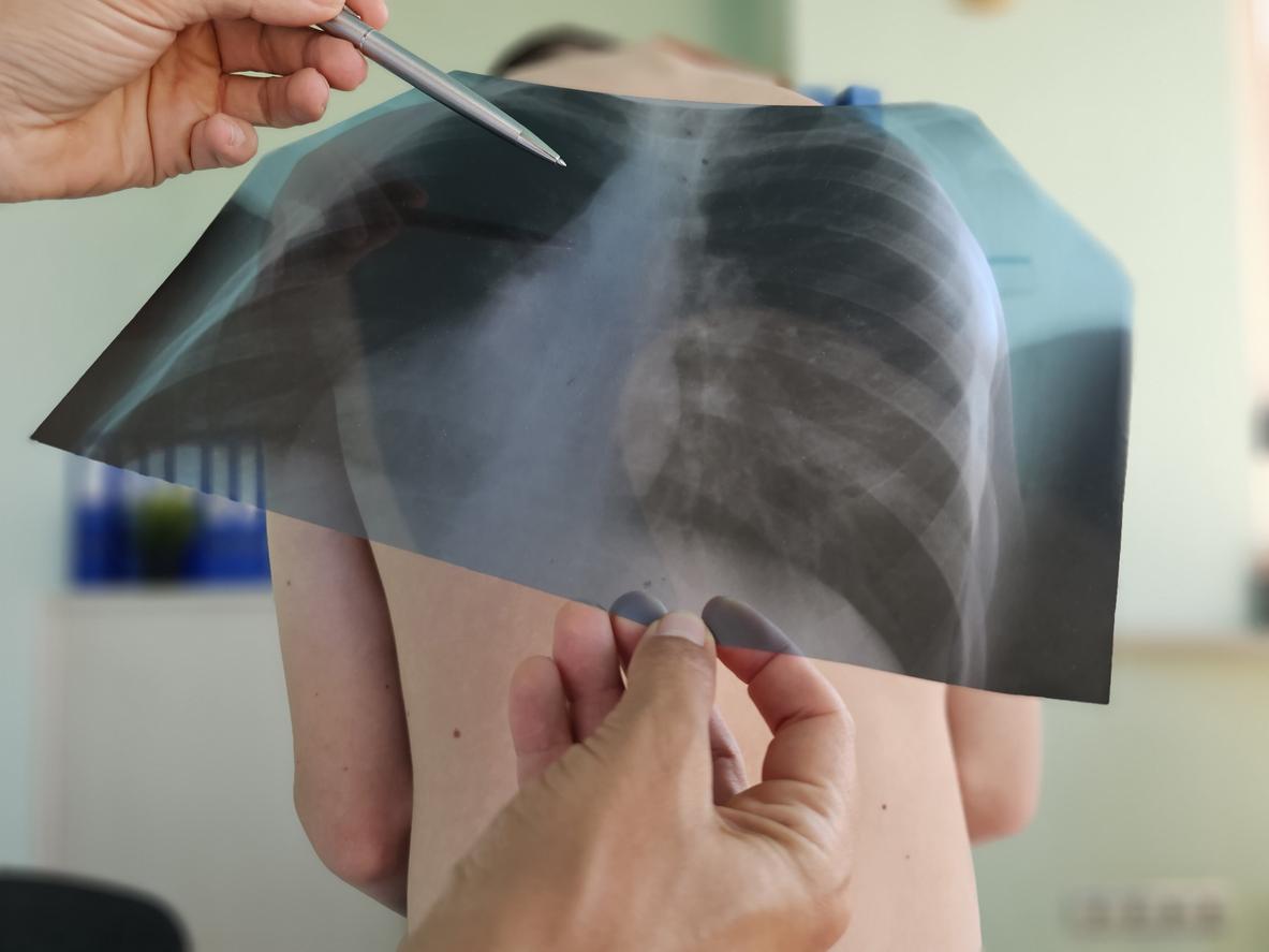 Tuberculose dans une école à Nîmes : comment prévenir la maladie ? 