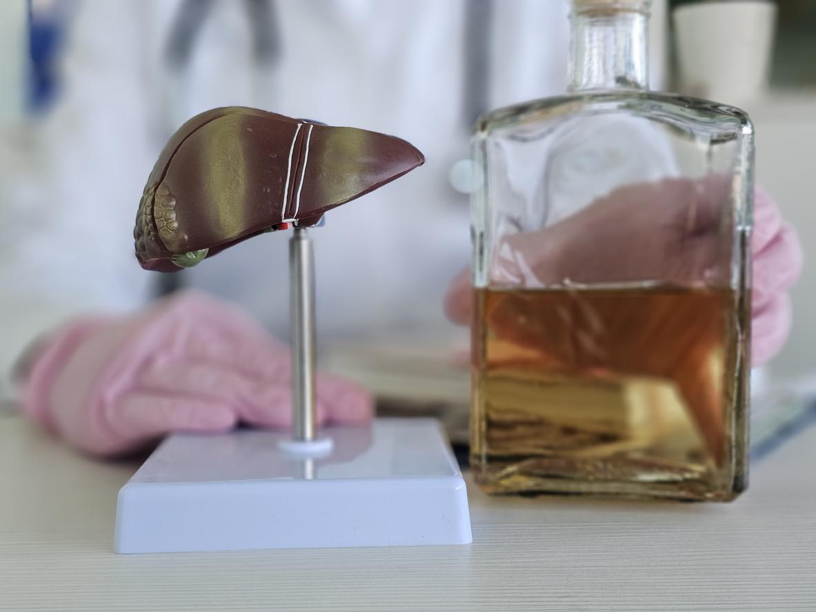 Hépatite alcoolique : le décès d'un parent par maladie hépatique double le risque 