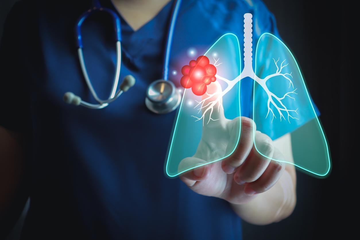 Bientôt un médicament pour prévenir le cancer du poumon ?