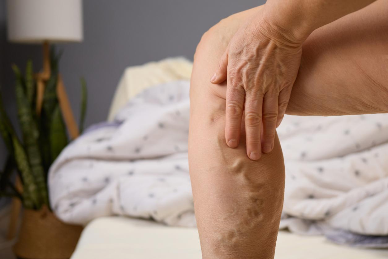 Varices : pourquoi ces traitements doivent être utilisés avec prudence 