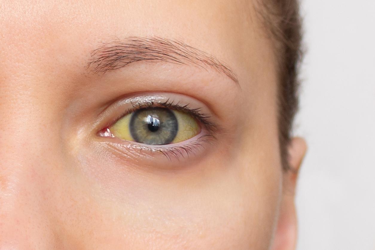 Cancer du pancréas : ce signe n'est pas forcément un symptôme de la maladie