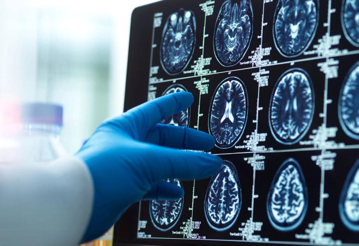 Troubles de la vision en avion : c’était une tumeur cérébrale