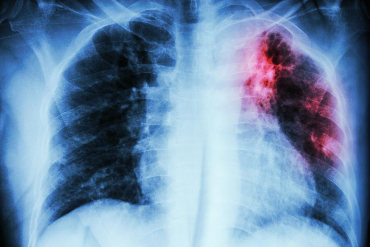 Diagnostic de la tuberculose : une IA aussi performante que les radiologues