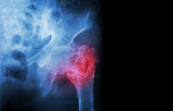 Ostéoporose : les traitements sont-ils mauvais pour les dents ?