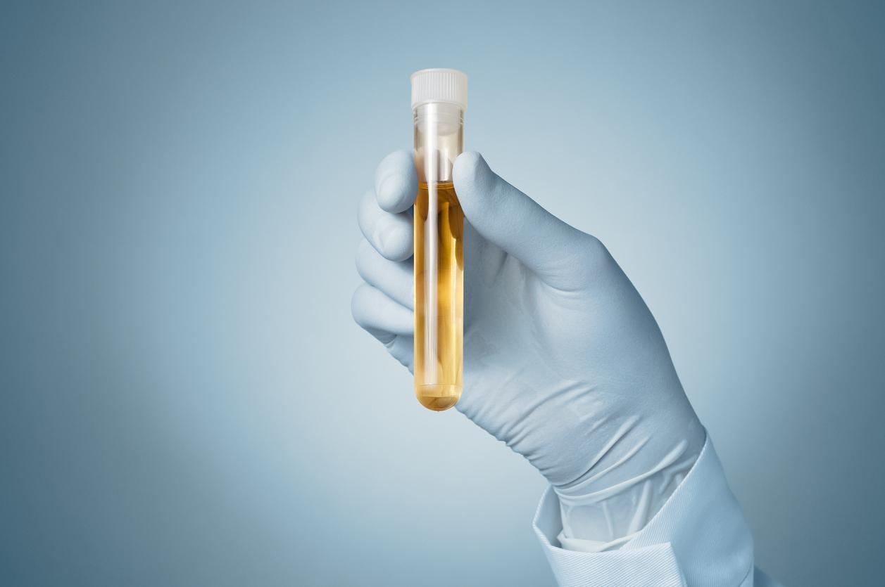 Cancer de la vessie : un test urinaire pour le détecter des années avant les symptômes