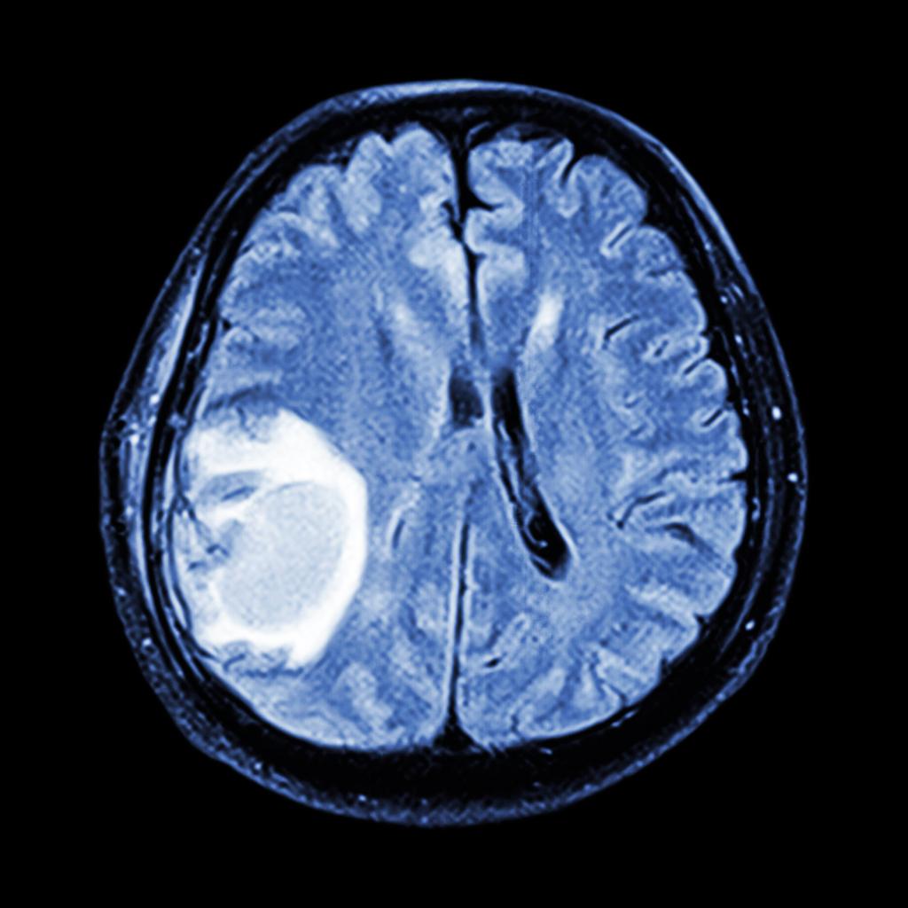 Androcur : les nouveaux patients devront être informés du risque de tumeur au cerveau