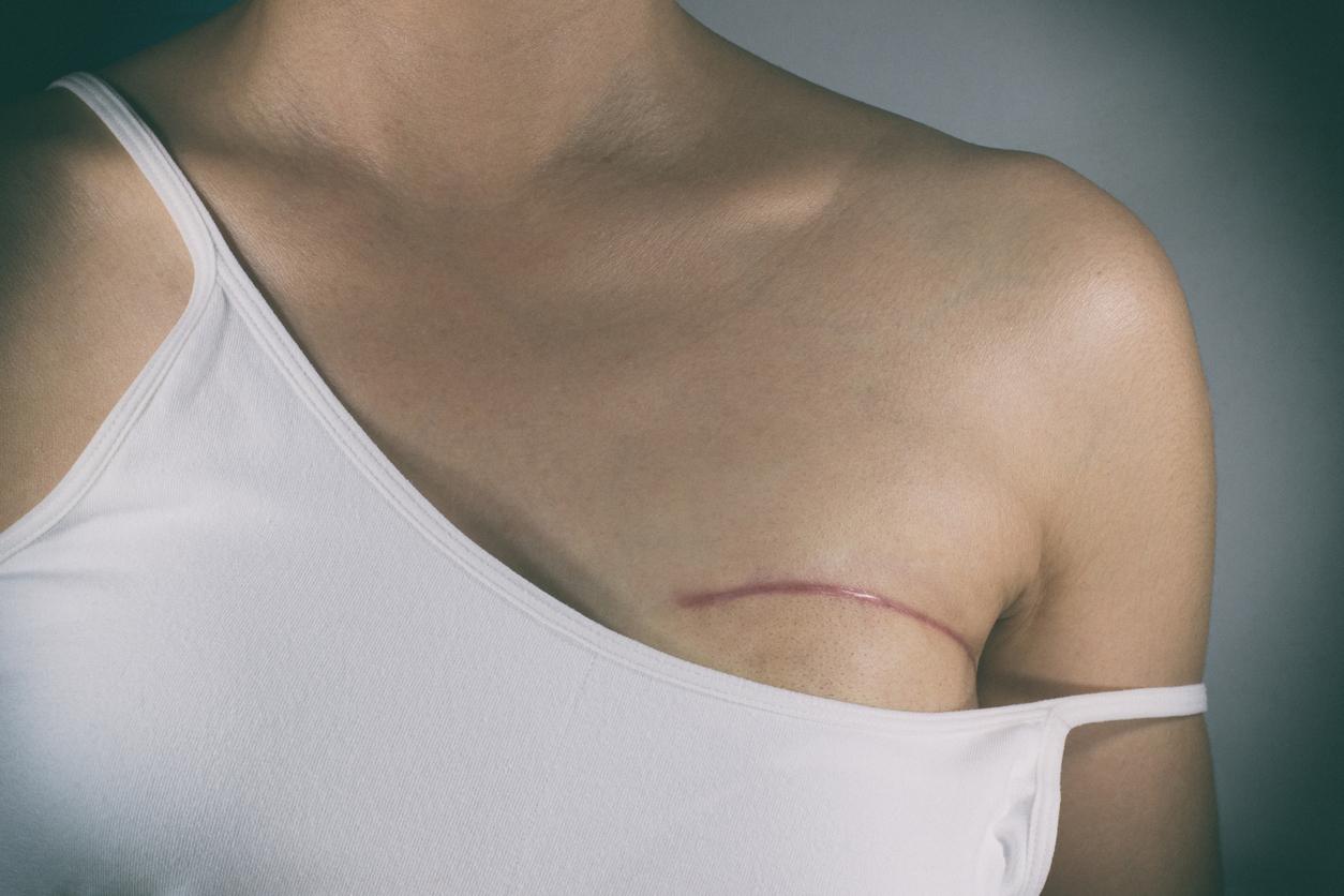 Cancer du sein : cette carence augmente les douleurs post-chirurgicales