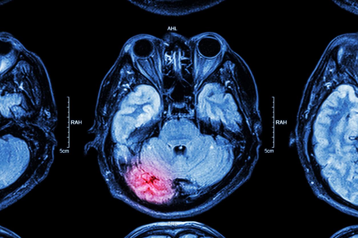 Cancer du cerveau : les blessures à la tête pourraient être un facteur de risque