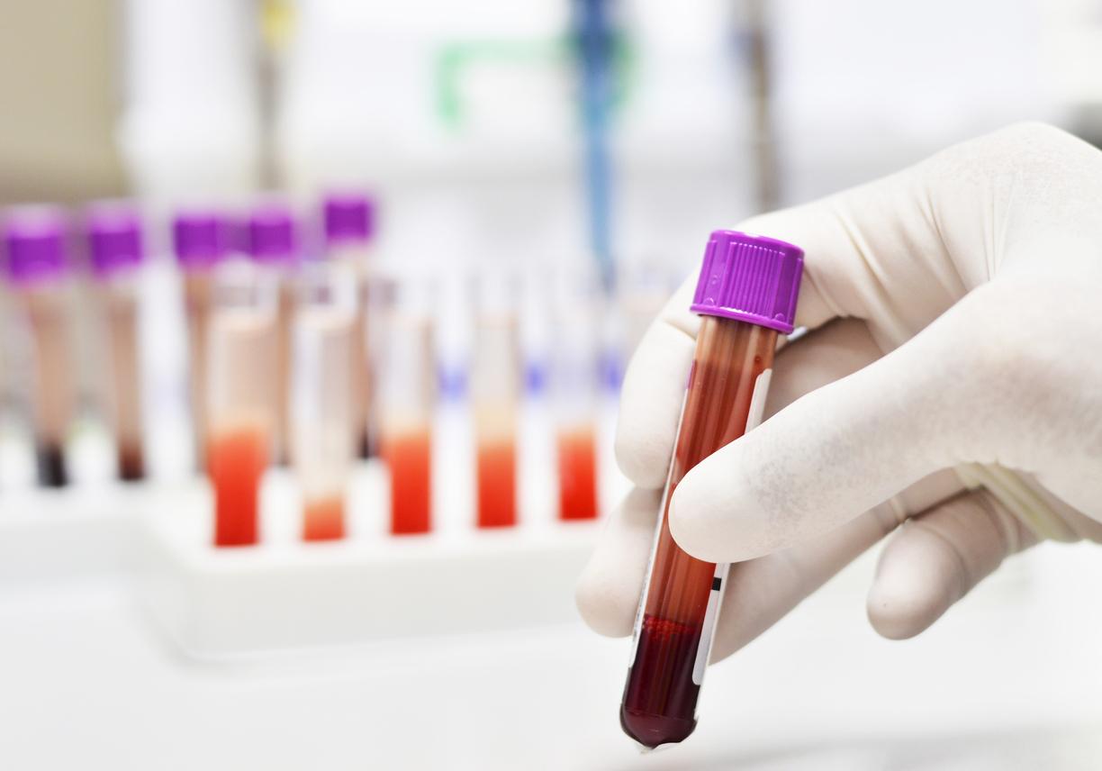 Cancer colorectal : un test sanguin pour savoir si la chimiothérapie est nécessaire 