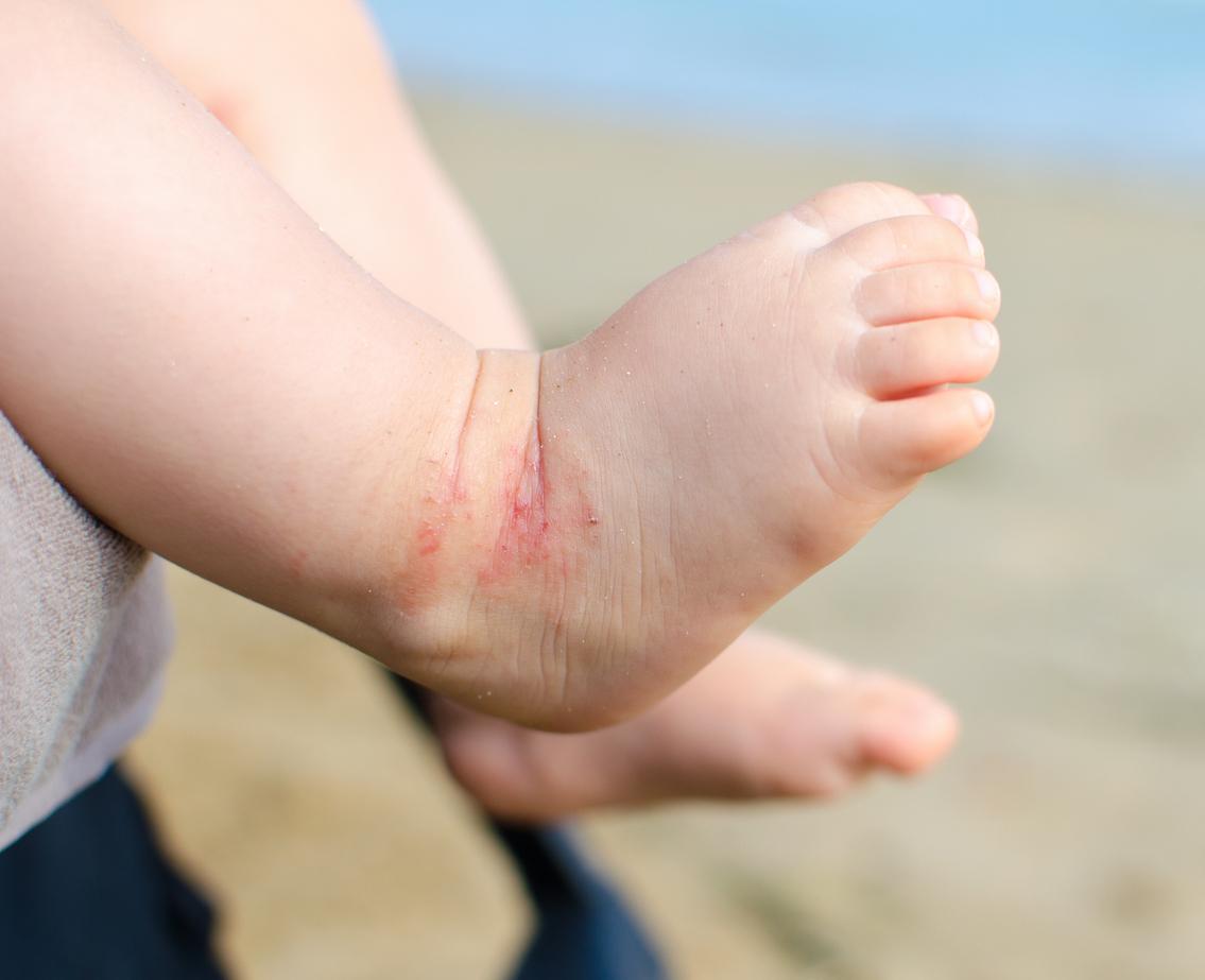 Dermatite atopique : elle augmenterait le risque de fractures chez l'enfant