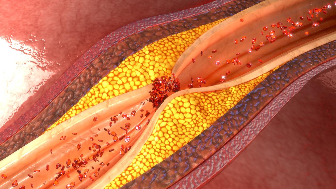 Athérosclérose : comment prévenir le risque d’artères obstruées ? 
