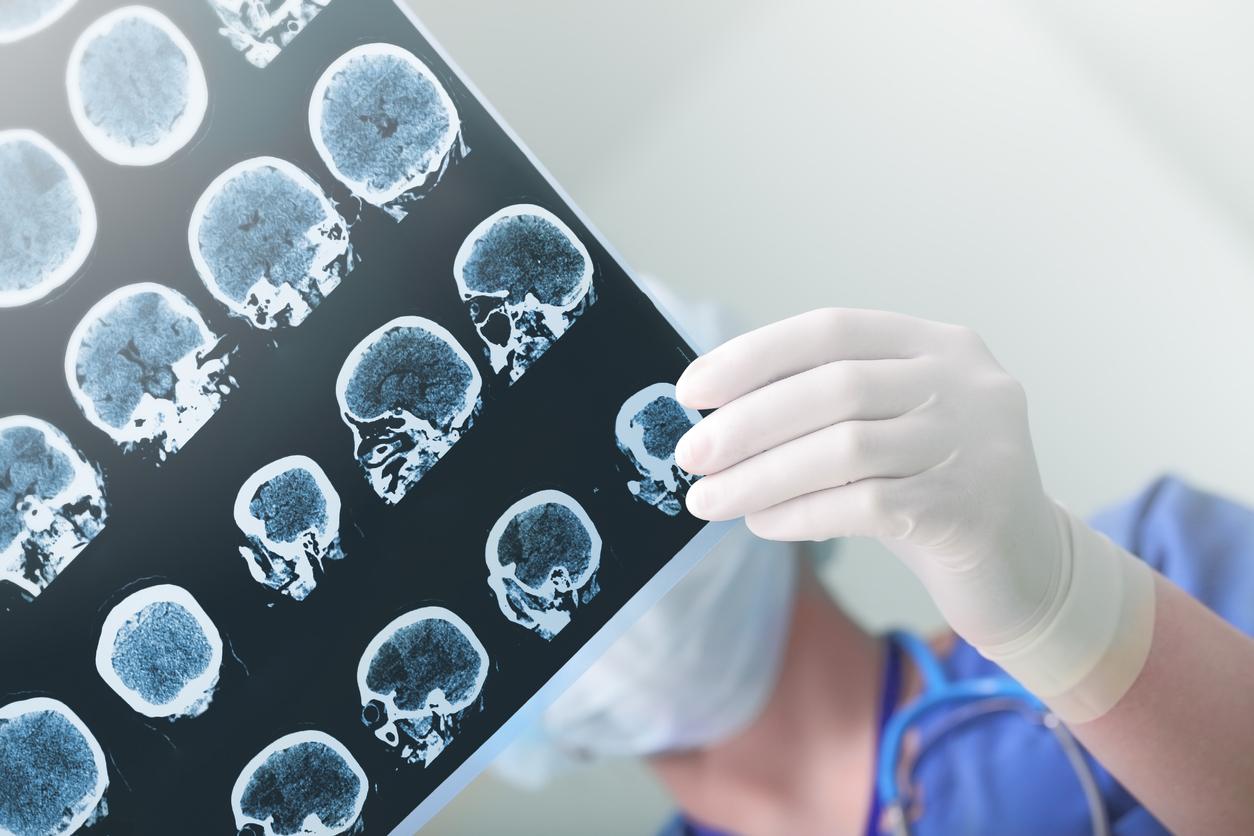 Alzheimer : des zones du cerveau s'atrophient avant l’apparition des premiers symptômes