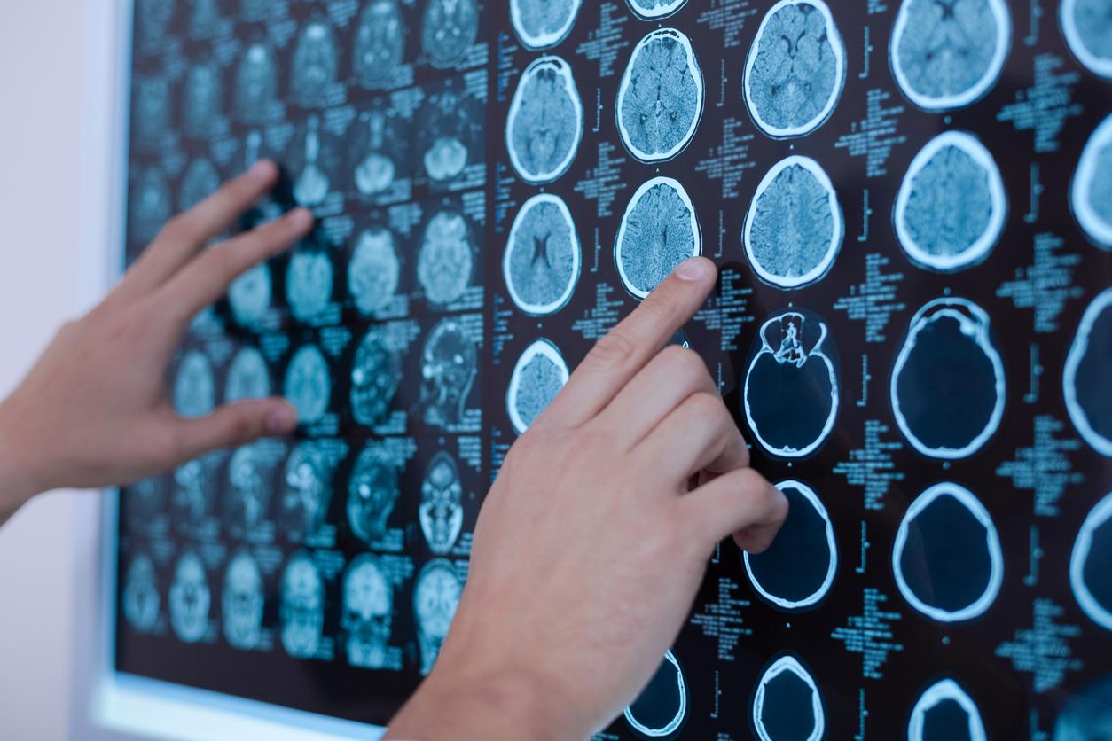 Quatre ans après son retour d’Inde, elle découvre 38 larves de parasite dans son cerveau