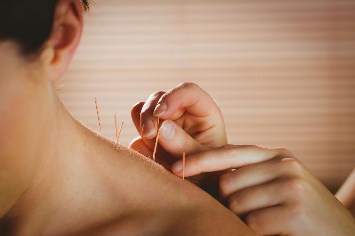 Ménopause : l’acupuncture peut réduire les bouffées de chaleur